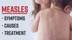 Measles: The Silent Invader